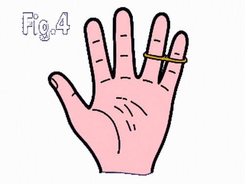 Palm is opened to reveal that the band has jumped to two different fingers.